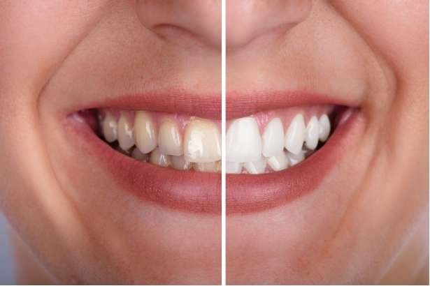 The Science Behind Teeth Whitening