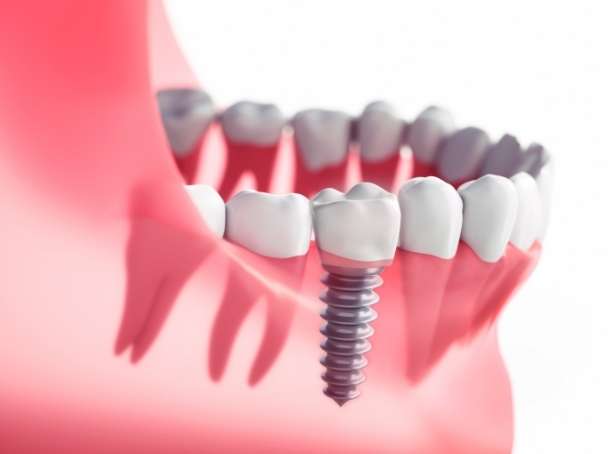 How Dental Implants Were Invented