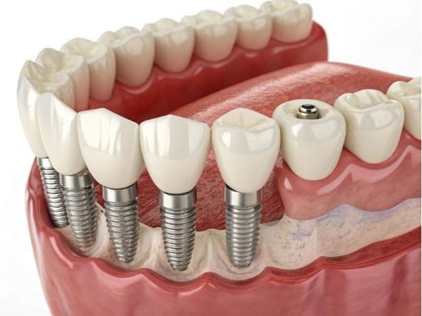 How Long Do Dental Implants Last?