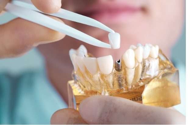 Diagram of bone regeneration with implant-supported dentures.
