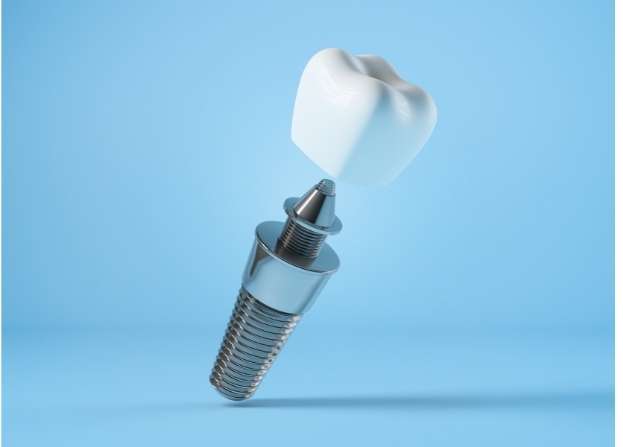 Dental implant placement in jawbone