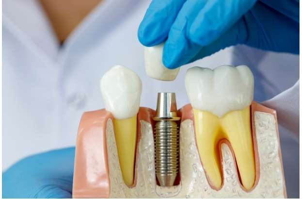 Jawbone with mini dental implants