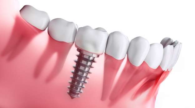 Mini dental implants with dentures attached