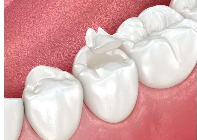 Dentist applying inlay on molar