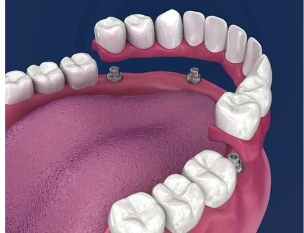 Close-up of implant-supported dentures attached to dental implants.