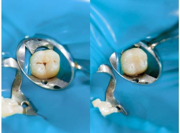 Tooth illustration showing dental sealant application