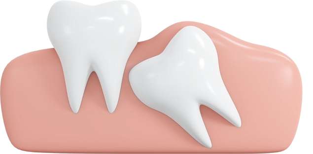 Impacted wisdom teeth illustration