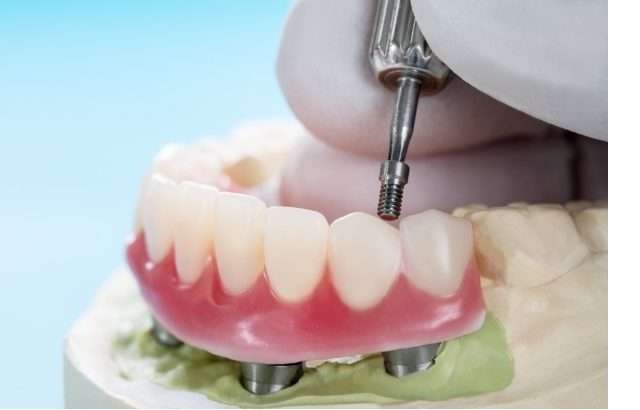 Illustration of a dental implant-supported bridge