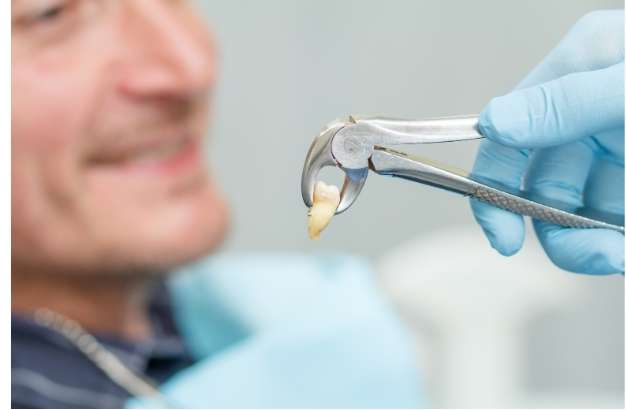 Simple vs. Surgical Tooth Extraction