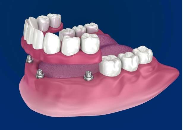 Understanding the All-on-4 process All-on-4 dental implant process diagram