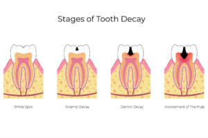 stages of tooth decay